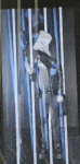 Twisted video display